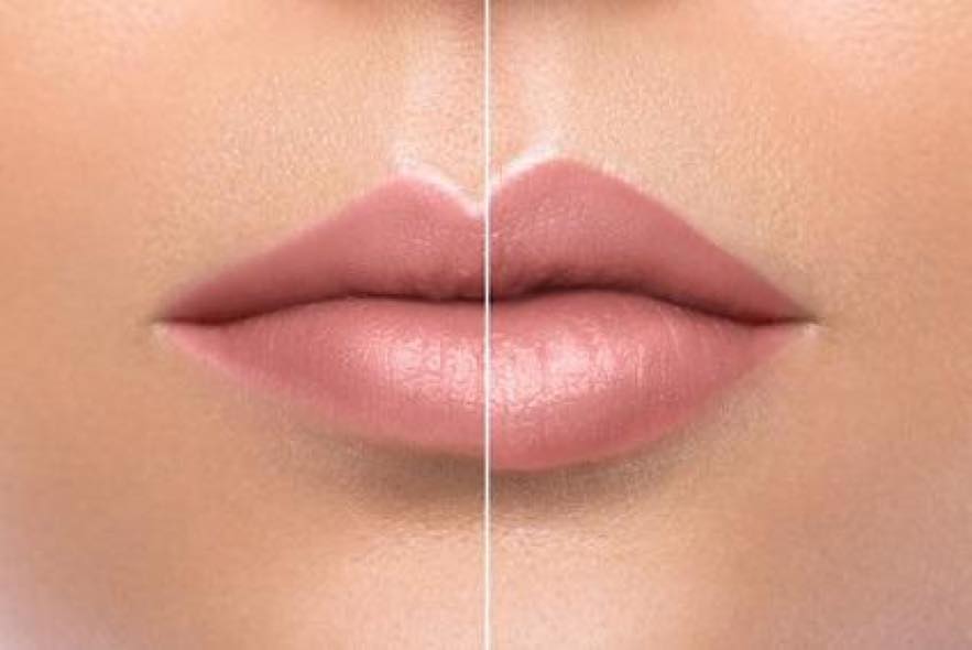 Before & After Restylane Kysse Lip Filler