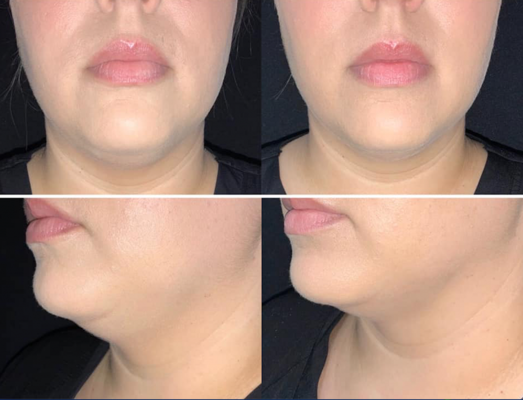 Kybella Before & After