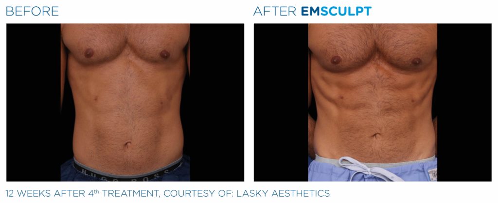 Emsculpt Neo – Body Shaping Results to Get Excited About